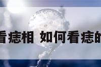怎么看痣相 如何看痣的好坏